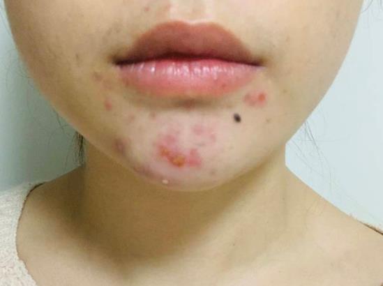 下巴長痘怎么辦?下巴長痘的原因