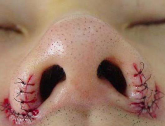 怎么做鼻翼縮小手術(shù)?做鼻翼縮小手術(shù)注意事項(xiàng)