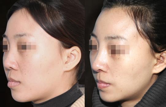鼻小柱延長手術效果如何?墊鼻小柱材料有哪些?