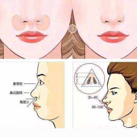 墊鼻基底有哪些材料?墊鼻基底安全嗎?