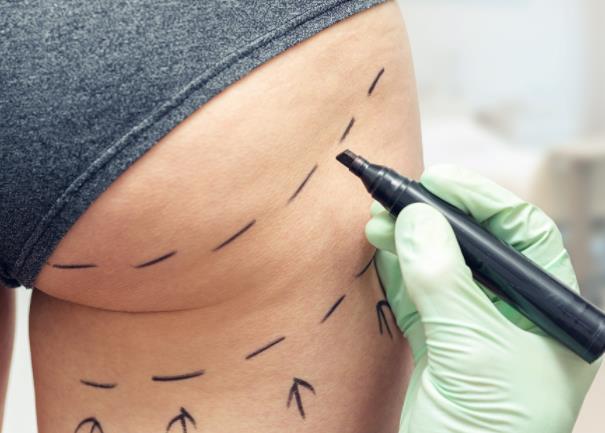 如何拯救葫蘆臀?臀部整形的方法有哪些?