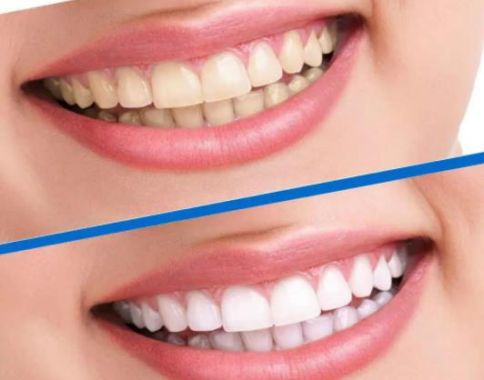 美白牙貼飯前貼還是飯后貼?牙貼可以剪下來一顆一顆貼嗎