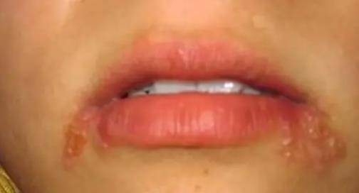 嘴上皰疹是上火還是病毒 嘴上皰疹可以吃海鮮嗎