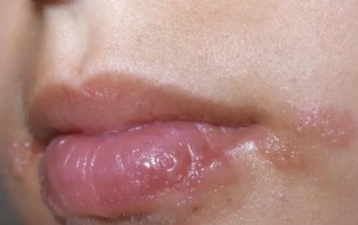 嘴上皰疹是上火還是病毒 嘴上皰疹可以吃海鮮嗎