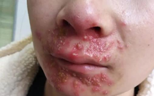 嘴上皰疹會傳染嗎 嘴上皰疹有膿要擠掉嗎