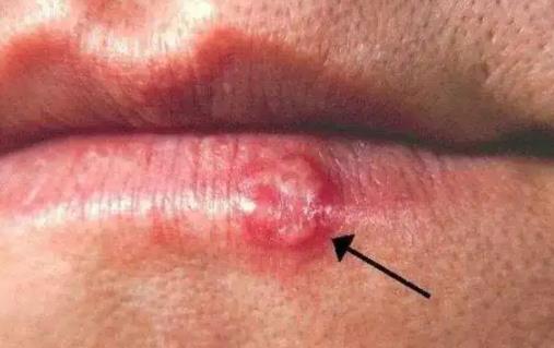 嘴上皰疹會傳染嗎 嘴上皰疹有膿要擠掉嗎