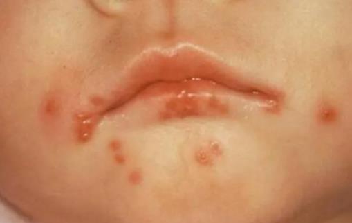 嘴上皰疹會留疤嗎 嘴上的皰疹會傳染身體其他部位嗎