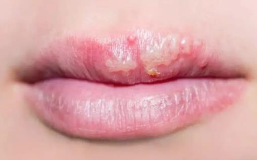 嘴上皰疹會留疤嗎 嘴上的皰疹會傳染身體其他部位嗎