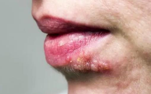 嘴上皰疹會留疤嗎 嘴上的皰疹會傳染身體其他部位嗎