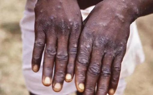 ����(n��i)��Ⱦ�ﶻ�����Ŀ����Դ�� �˸�Ⱦ�ﶻ������������