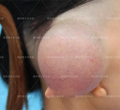 余文林:耳再造手術為什么擴張全包法更逼真美觀?