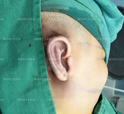 余文林:耳再造手術為什么擴張全包法更逼真美觀?