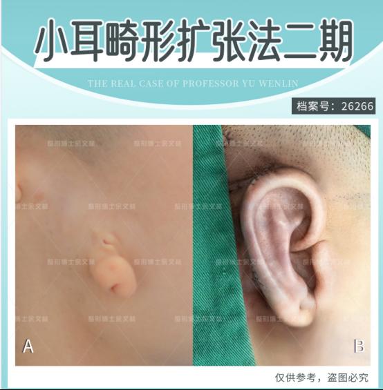 余文林:耳再造手術為什么擴張全包法更逼真美觀?