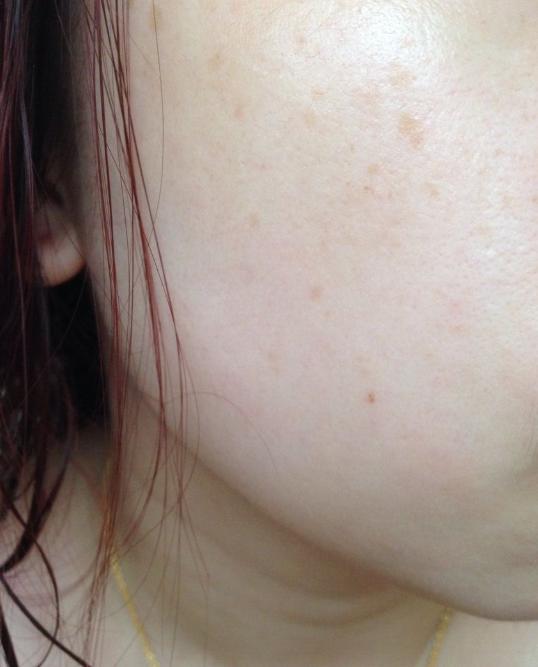 濟南麗合王偉注射怎么樣?醫生簡介、技術實力揭曉!_個人案例_電話預約 濟南麗合王偉注射怎么樣?醫生簡介、技術實力揭曉!_個人案例_電話預約