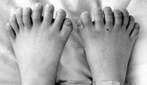 世界上手指腳趾最多的人 印度男孩34根破紀錄 手14腳20