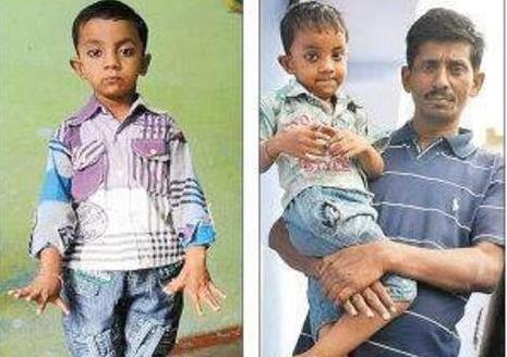 世界上手指腳趾最多的人 印度男孩34根破紀錄 手14腳20