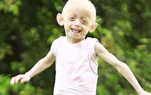 世界上最老的孩子 塞斯·庫克12歲的年紀90歲的面容