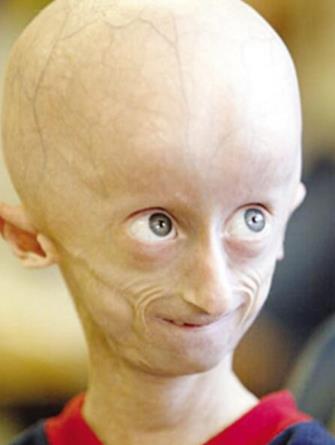 世界上最老的孩子 塞斯·庫克12歲的年紀90歲的面容