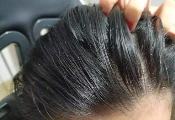 油性頭發脫發怎么辦?怎么選擇護發素?