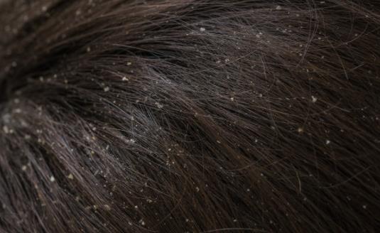 去頭皮屑有哪些秘方?頭皮發癢怎么辦?