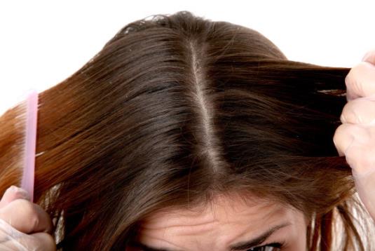 去頭皮屑有哪些秘方?頭皮發癢怎么辦?