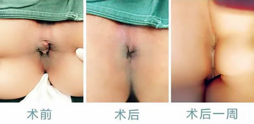 女性痔瘡真人實拍圖片 網上曝光的7個小偏方有效治痔瘡 女性痔瘡真人實拍圖片 網上曝光的7個小偏方有效治痔瘡