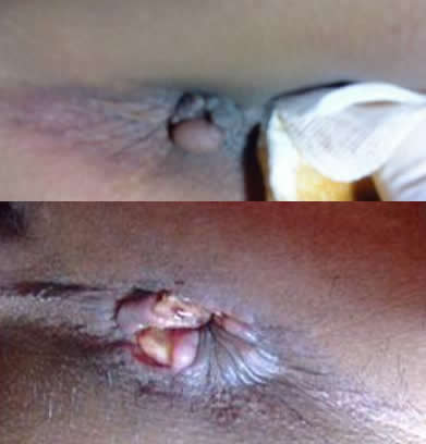 女性痔瘡真人實拍圖片 網上曝光的7個小偏方有效治痔瘡 女性痔瘡真人實拍圖片 網上曝光的7個小偏方有效治痔瘡