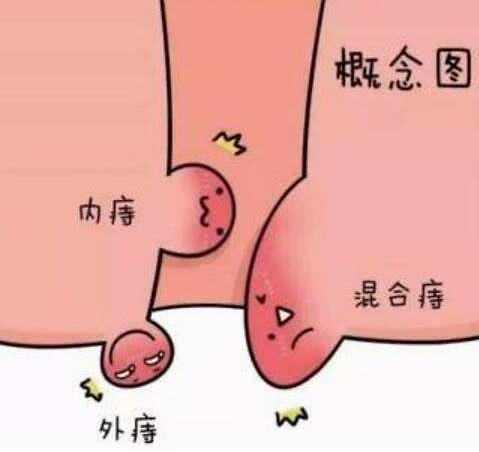 女性痔瘡真人實拍圖片 網上曝光的7個小偏方有效治痔瘡 女性痔瘡真人實拍圖片 網上曝光的7個小偏方有效治痔瘡