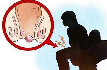 女性痔瘡真人實拍圖片 網上曝光的7個小偏方有效治痔瘡 女性痔瘡真人實拍圖片 網上曝光的7個小偏方有效治痔瘡