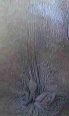 女性痔瘡的圖片,痔瘡的臨床表現、檢查、診斷及手術治療