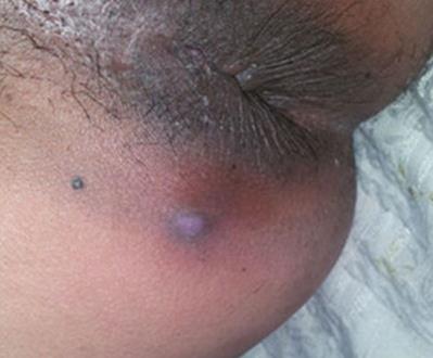 女性痔瘡的圖片,痔瘡的臨床表現、檢查、診斷及手術治療