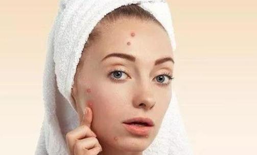 為什么月經期會長痘?怎么預防經期長痘?