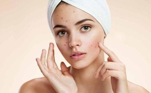 為什么月經期會長痘?怎么預防經期長痘?