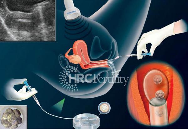 1686301744374204.jpg 囊胚移植-600-HRC水印.jpg