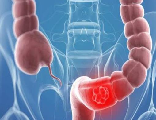 世界十大疑難雜癥排名,腸癌、心臟病困擾著患者