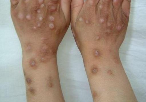 世界上十大必死病排名,狂犬病、晚期癌癥死亡率非常高