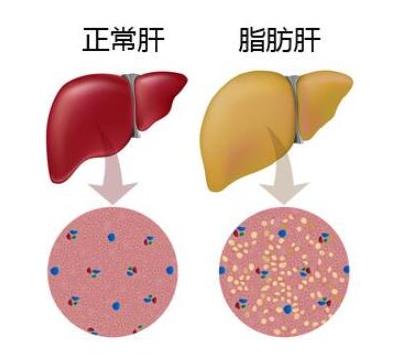 十大男性高發疾病排行榜,肺癌和吸煙有關、肝癌愛找上男人