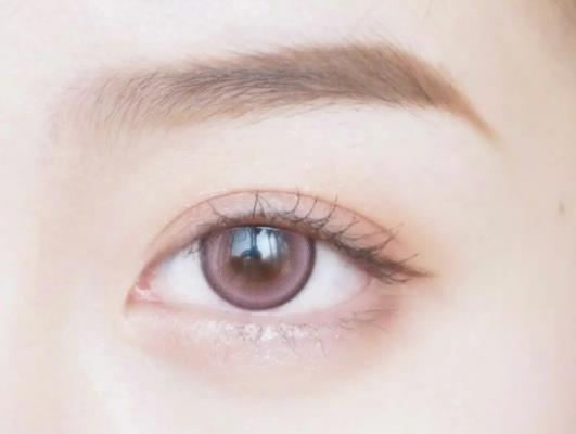 割雙眼皮疤痕疙瘩多久能消失?雙眼皮疤痕周?chē)芏嘈「泶裨趺崔k 割雙眼皮疤痕疙瘩多久能消失?雙眼皮疤痕周?chē)芏嘈「泶裨趺崔k