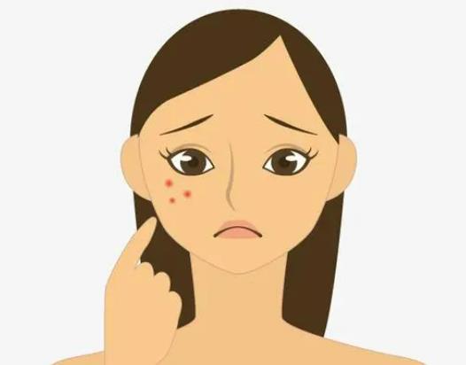 痘印相信鏡子還是相機?激素臉什么都不擦能自己修復好嗎 痘印相信鏡子還是相機?激素臉什么都不擦能自己修復好嗎
