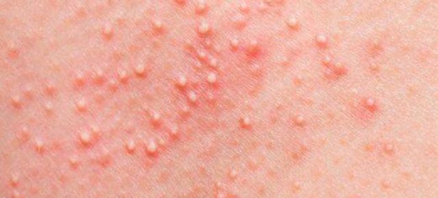 熱疹的發病因素 熱疹的類型 熱疹的發病因素 熱疹的類型