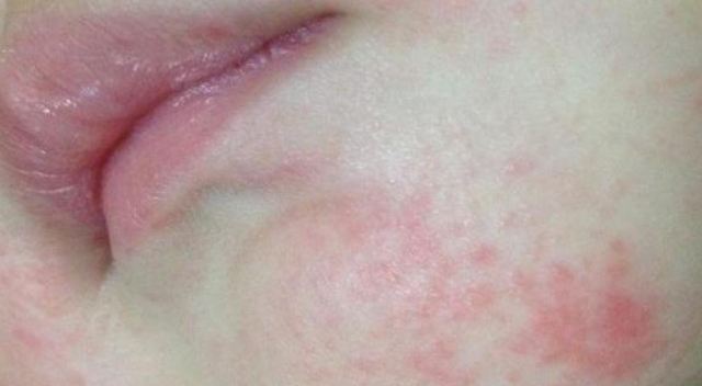 熱疹的發病因素 熱疹的類型 熱疹的發病因素 熱疹的類型