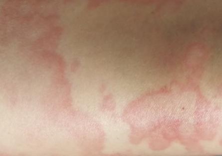 打破傷風(fēng)過敏怎么辦 對(duì)破傷風(fēng)針過敏打什么藥 打破傷風(fēng)過敏怎么辦 對(duì)破傷風(fēng)針過敏打什么藥