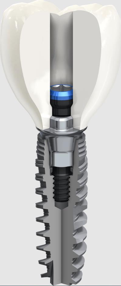 韓泰種植體是高端植體嗎? 韓泰種植體是高端植體嗎?