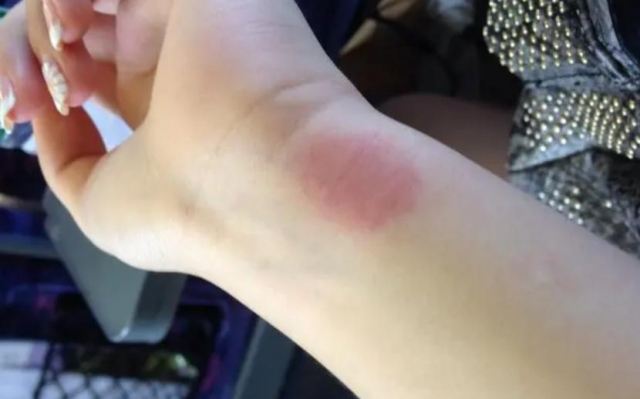 芒果過(guò)敏原因是什么呢 如何判斷是不是芒果過(guò)敏 芒果過(guò)敏原因是什么呢 如何判斷是不是芒果過(guò)敏