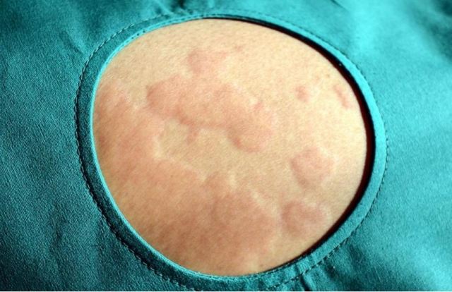 吃芒果需要注意什么?重度過(guò)敏有什么癥狀 吃芒果需要注意什么?重度過(guò)敏有什么癥狀