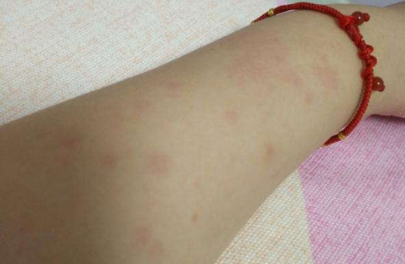 吃芒果過敏有哪些癥狀 芒果過敏可以喝楊枝甘露嗎 吃芒果過敏有哪些癥狀 芒果過敏可以喝楊枝甘露嗎