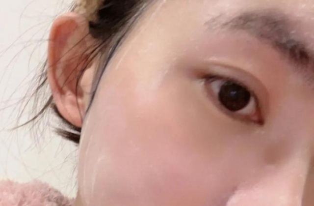 臉上長痤瘡可以用上海藥皂洗臉嗎 前胸長痘痘可以用藥皂嗎 臉上長痤瘡可以用上海藥皂洗臉嗎 前胸長痘痘可以用藥皂嗎