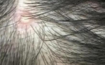 頭皮癢可以用上海藥皂洗頭嗎?頭上有螨蟲的癥狀 頭皮癢可以用上海藥皂洗頭嗎?頭上有螨蟲的癥狀