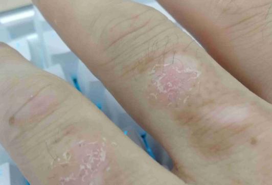 手癬干裂是什么原因?手癬干裂怎么治療最快 手癬干裂是什么原因?手癬干裂怎么治療最快