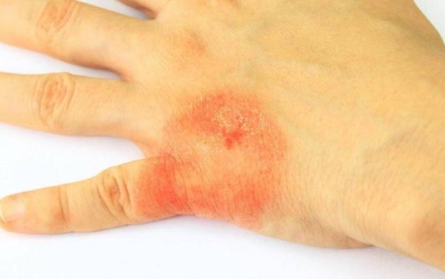 手癬可以徹底根治嗎?引起手癬的原因 手癬可以徹底根治嗎?引起手癬的原因